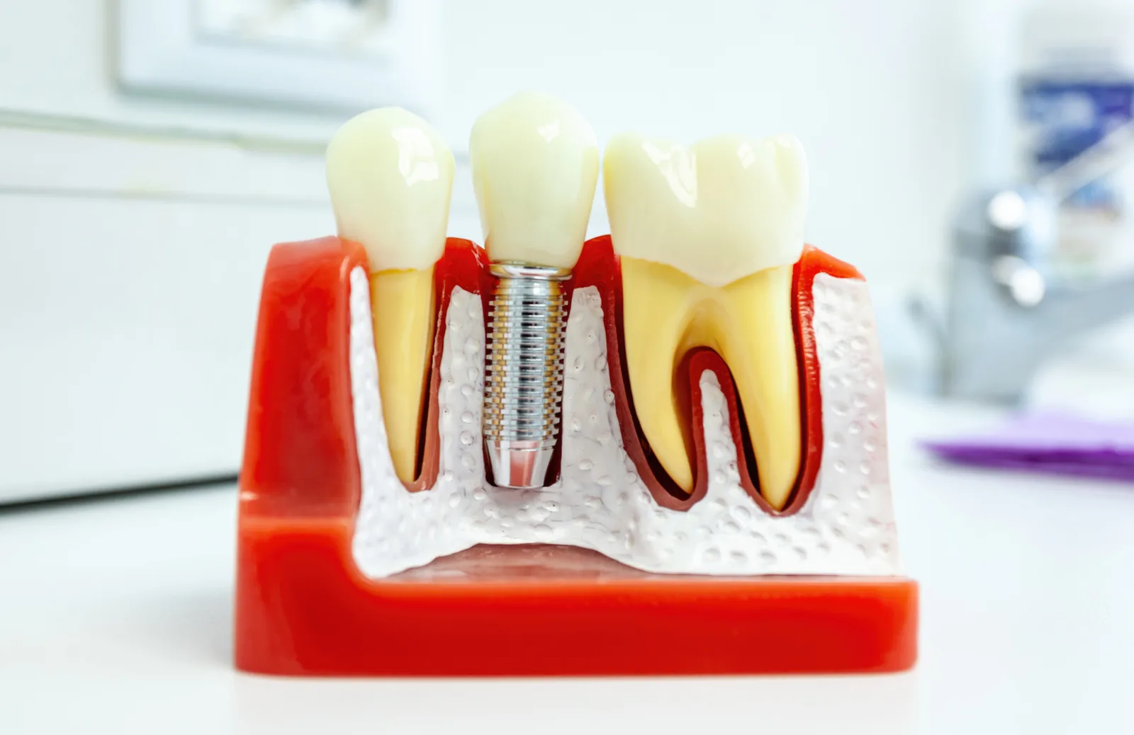 A sectioned dental teaching model on a bench in a treatment room, one titanium implant carrying a crown between a natural tooth and a sectioned molar, a basin and cabinetry blurred behind — illustrative example